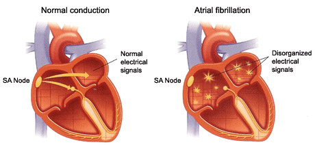 atrial fibrillation-1