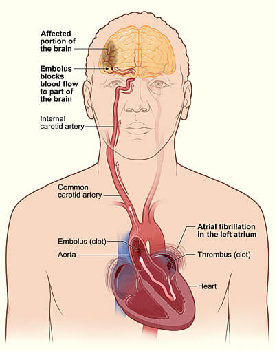 Atrial Fibrillation diagram