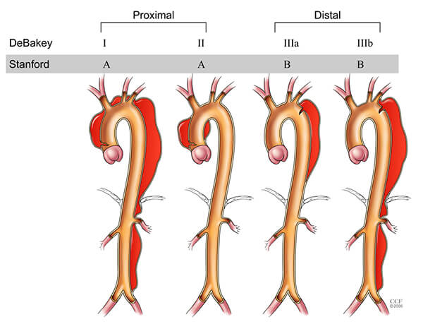aorta-dissection-classification