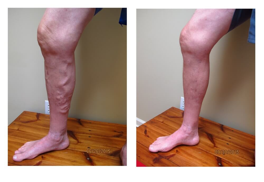 Varicose laser cumpara. Endovenous Varicose Vein Laser Treatment is available at: